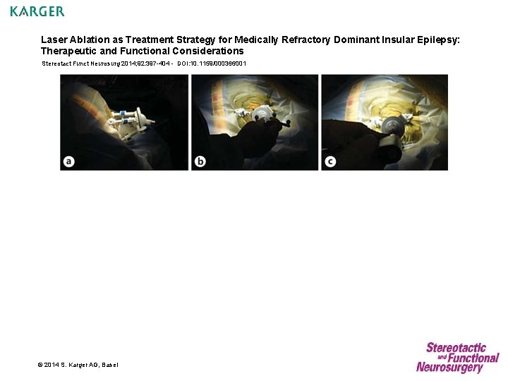 Laser Ablation as Treatment Strategy for Medically Refractory Dominant Insular Epilepsy: Therapeutic and Functional