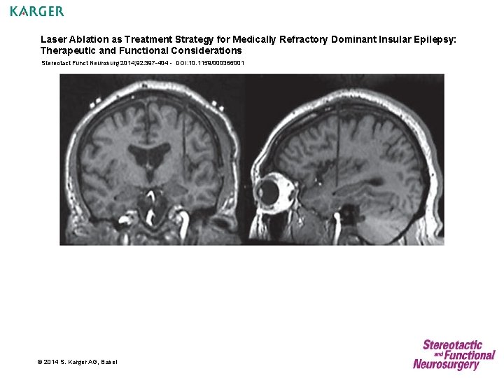 Laser Ablation as Treatment Strategy for Medically Refractory Dominant Insular Epilepsy: Therapeutic and Functional