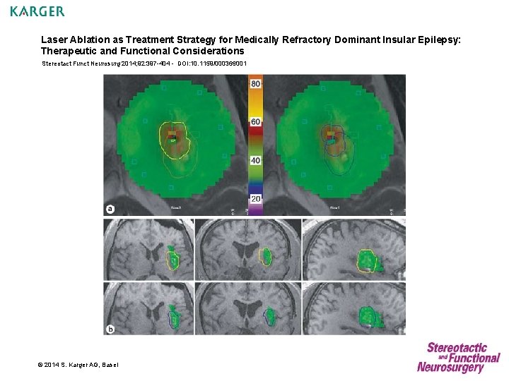 Laser Ablation as Treatment Strategy for Medically Refractory Dominant Insular Epilepsy: Therapeutic and Functional