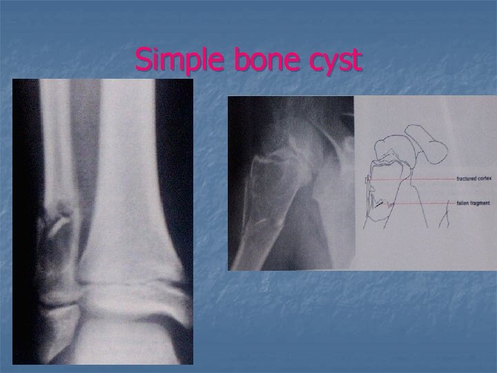 Simple bone cyst 
