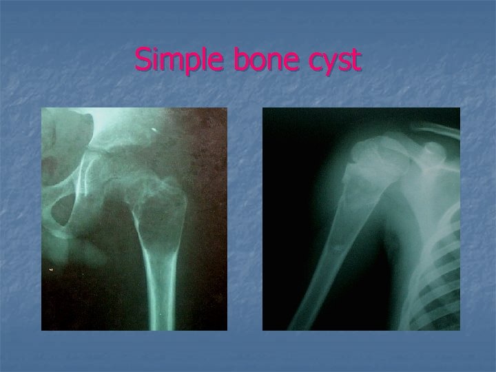 Simple bone cyst 