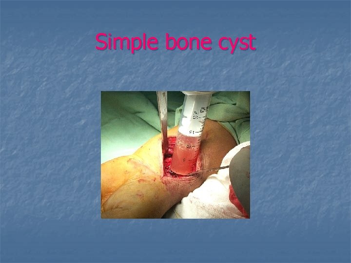 Simple bone cyst 