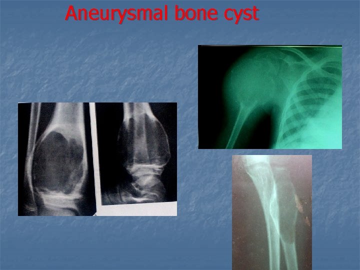 Aneurysmal bone cyst 