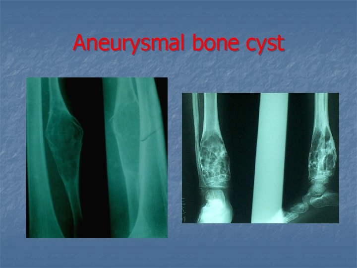 Aneurysmal bone cyst 