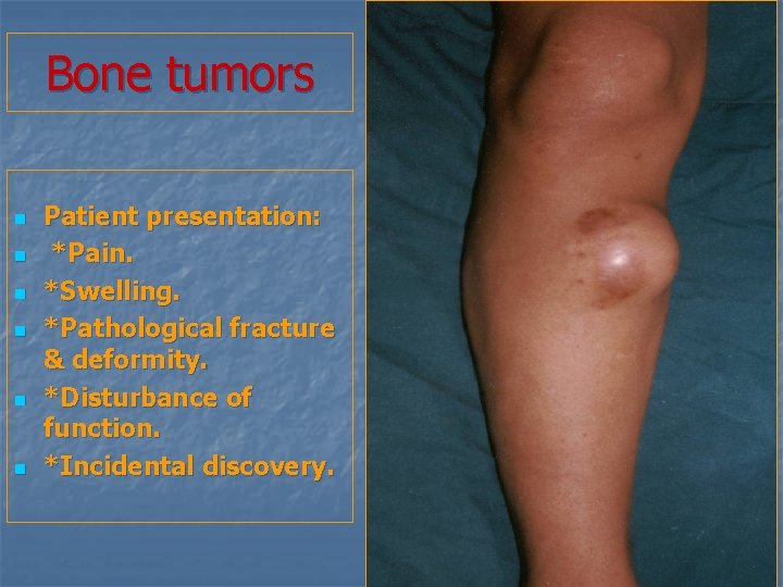 Bone tumors n n n Patient presentation: *Pain. *Swelling. *Pathological fracture & deformity. *Disturbance