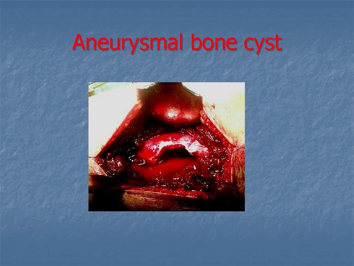 Aneurysmal bone cyst 