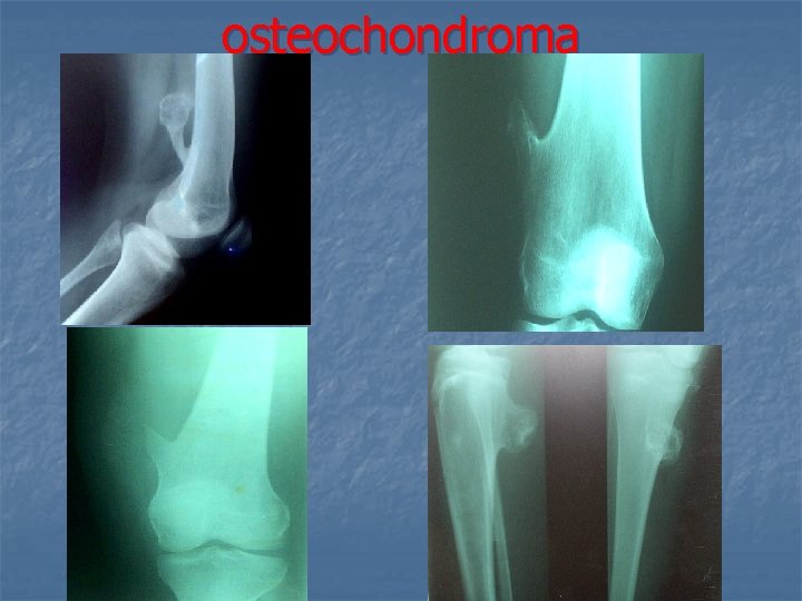 osteochondroma 