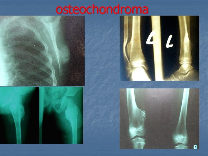 osteochondroma 