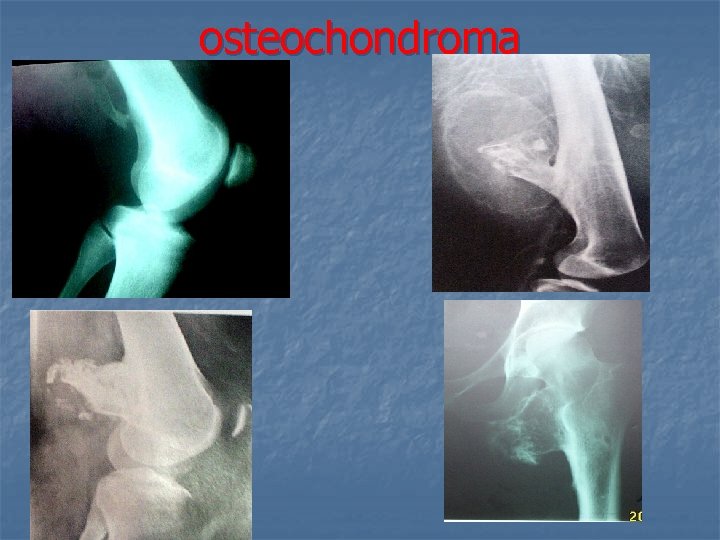 osteochondroma 