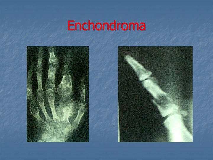 Enchondroma 