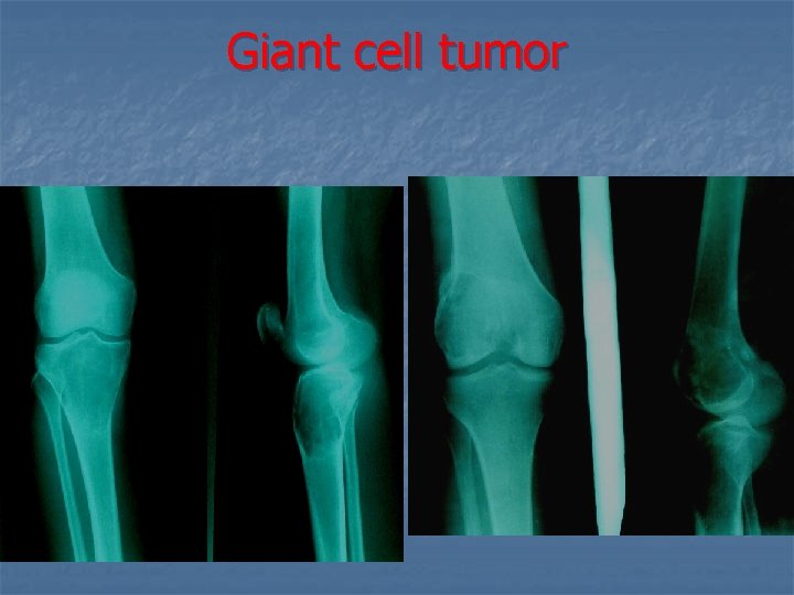 Giant cell tumor 