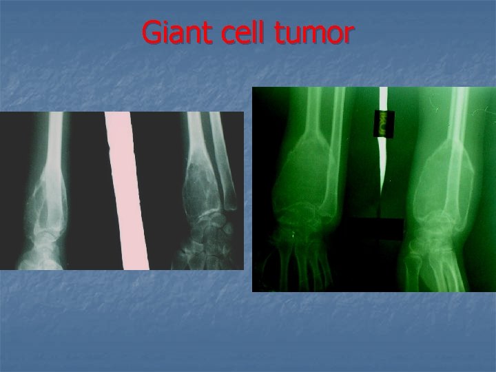 Giant cell tumor 
