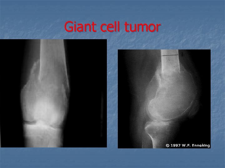 Giant cell tumor 