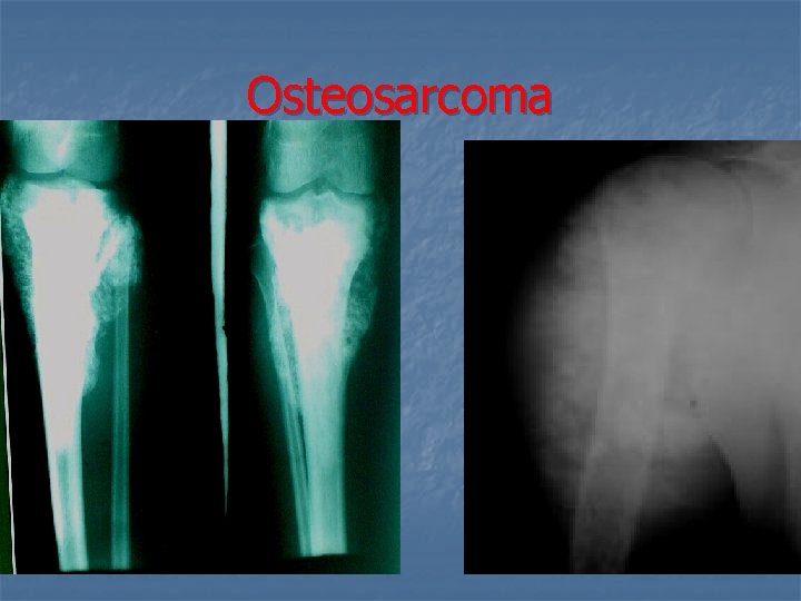 Osteosarcoma 