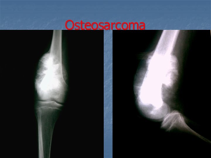 Osteosarcoma 