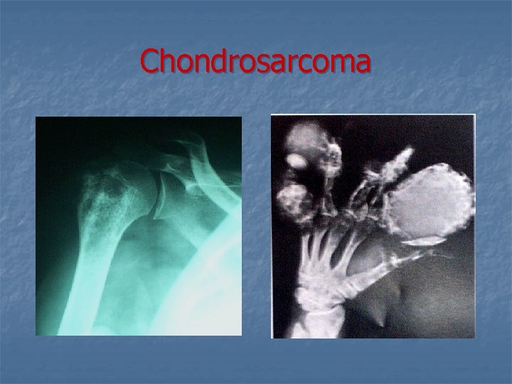 Chondrosarcoma 