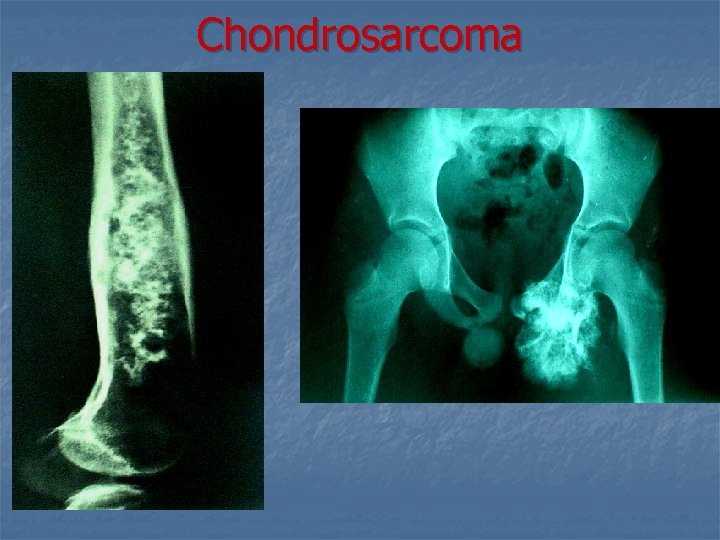 Chondrosarcoma 