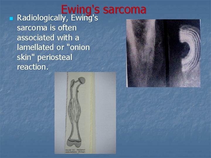 n Ewing's sarcoma Radiologically, Ewing's sarcoma is often associated with a lamellated or "onion