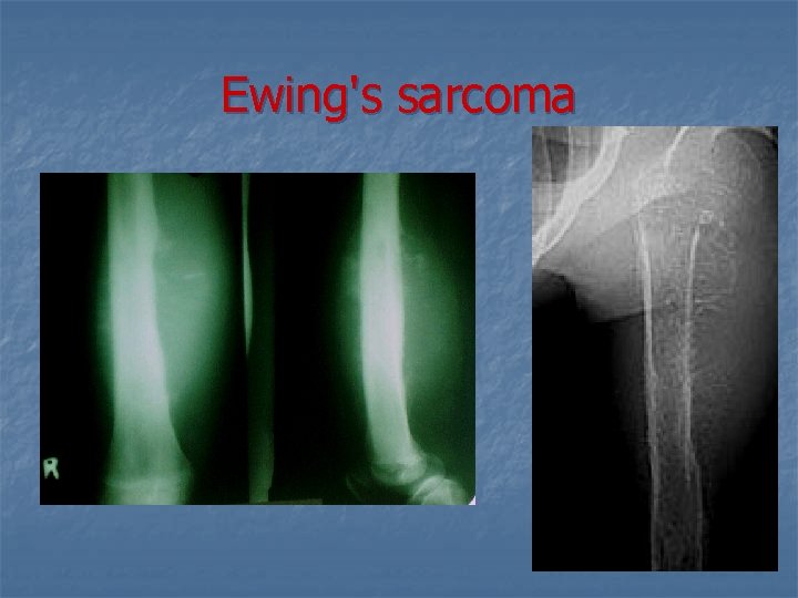 Ewing's sarcoma 