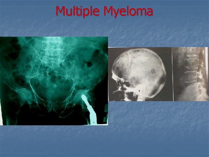 Multiple Myeloma 