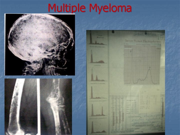 Multiple Myeloma 