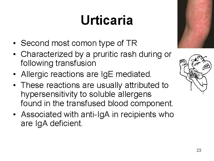 Urticaria • Second most comon type of TR • Characterized by a pruritic rash