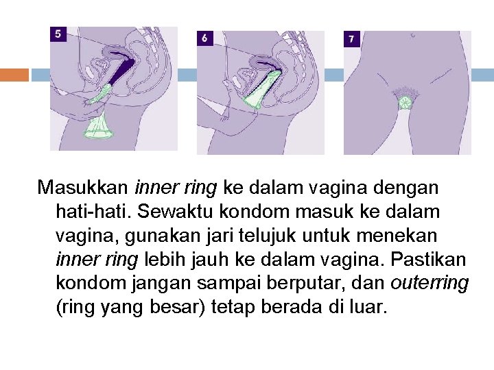 Masukkan inner ring ke dalam vagina dengan hati-hati. Sewaktu kondom masuk ke dalam vagina,