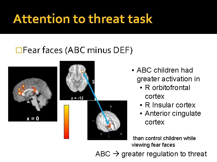 Attention to threat task �Fear faces (ABC minus DEF) R • ABC children had