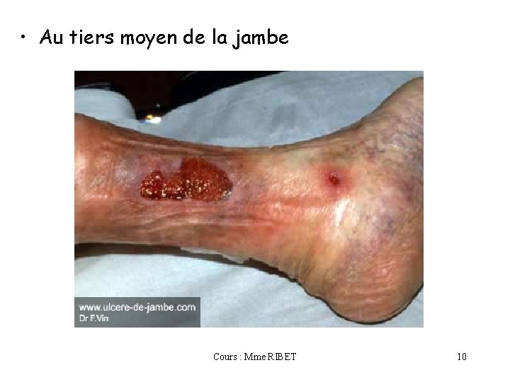  • Au tiers moyen de la jambe Cours : Mme RIBET 10 