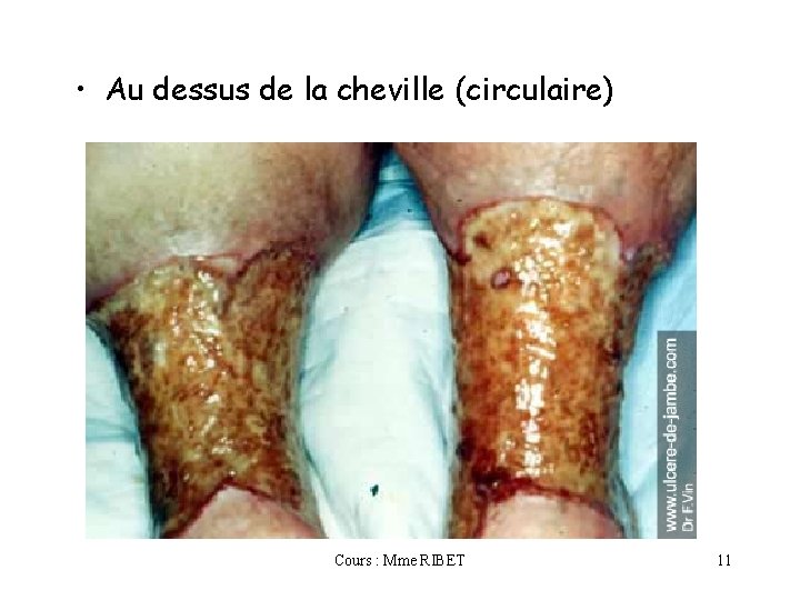  • Au dessus de la cheville (circulaire) Cours : Mme RIBET 11 