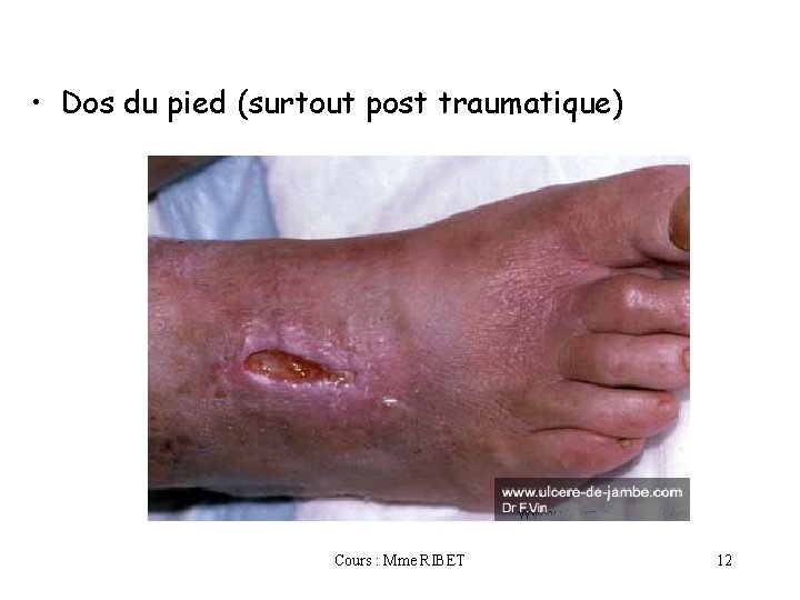  • Dos du pied (surtout post traumatique) Cours : Mme RIBET 12 