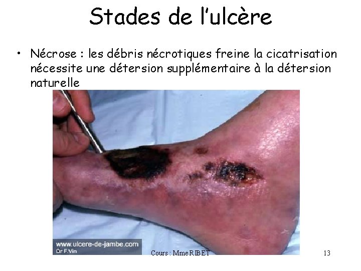 Stades de l’ulcère • Nécrose : les débris nécrotiques freine la cicatrisation nécessite une