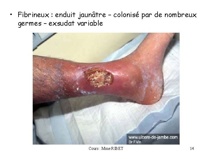  • Fibrineux : enduit jaunâtre – colonisé par de nombreux germes – exsudat