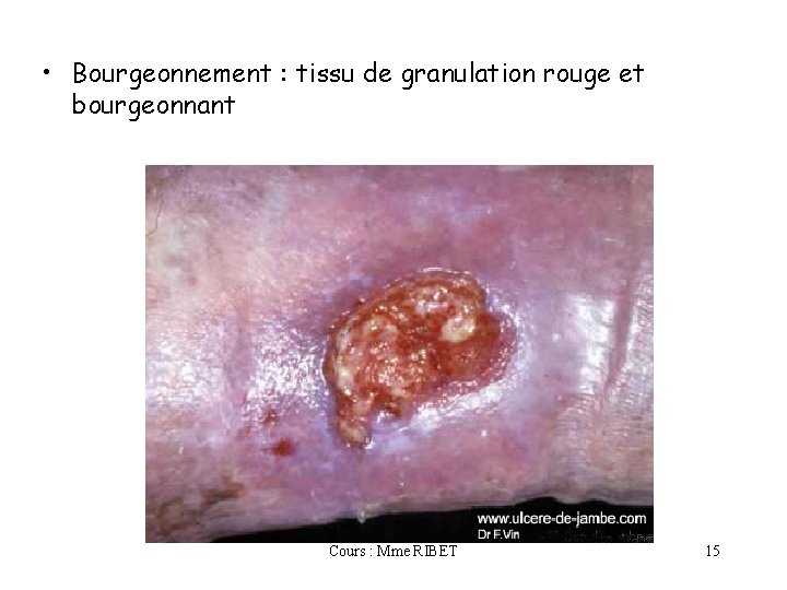  • Bourgeonnement : tissu de granulation rouge et bourgeonnant Cours : Mme RIBET