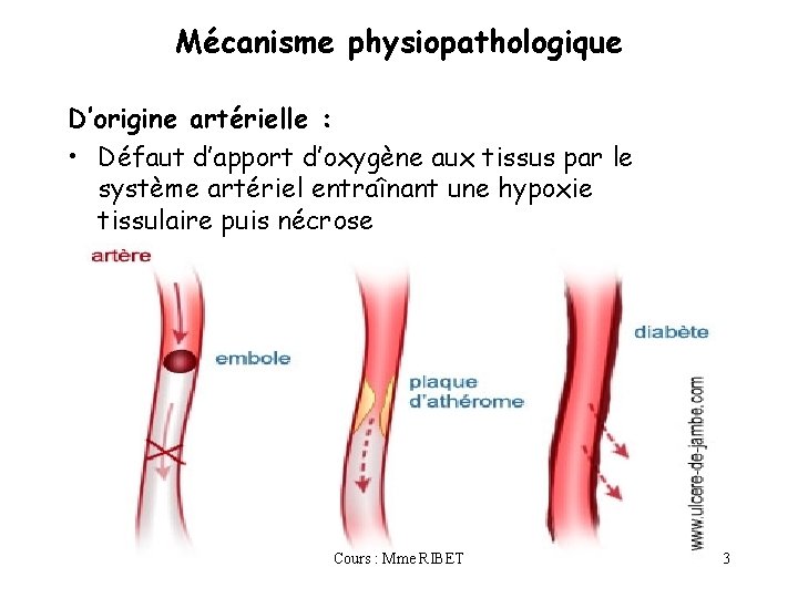 Mécanisme physiopathologique D’origine artérielle : • Défaut d’apport d’oxygène aux tissus par le système