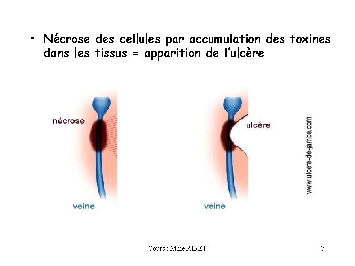  • Nécrose des cellules par accumulation des toxines dans les tissus = apparition