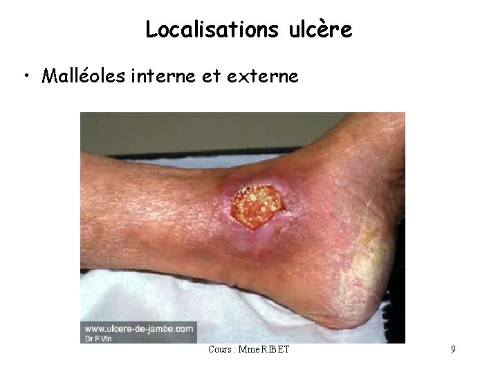 Localisations ulcère • Malléoles interne et externe Cours : Mme RIBET 9 