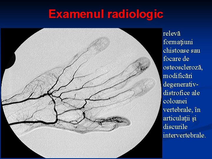 Examenul radiologic relevă formaţiuni chistoase sau focare de osteoscleroză, modificări degenerativdistrofice ale coloanei vertebrale,
