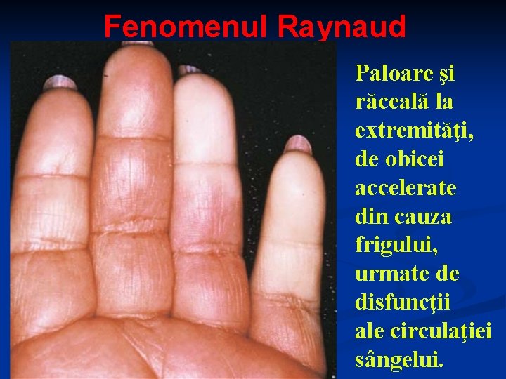 Fenomenul Raynaud Paloare şi răceală la extremităţi, de obicei accelerate din cauza frigului, urmate