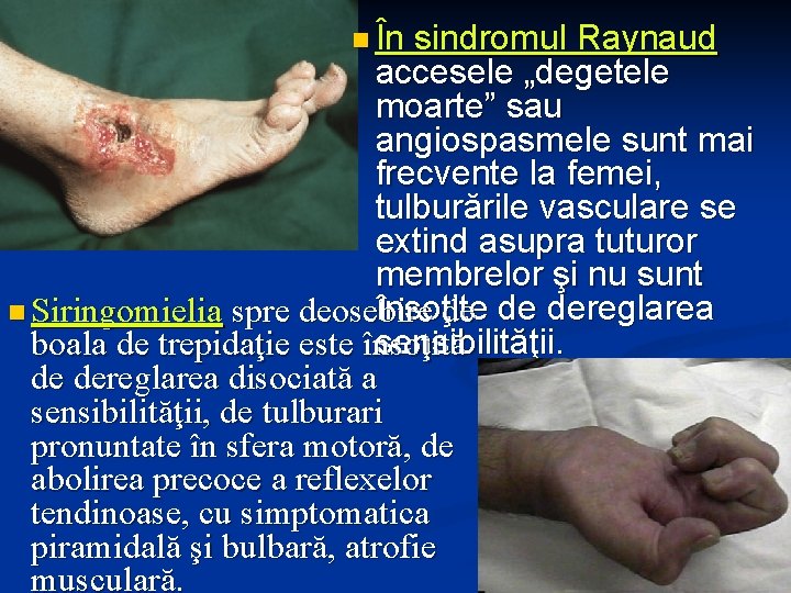 n În sindromul Raynaud accesele „degetele moarte” sau angiospasmele sunt mai frecvente la femei,