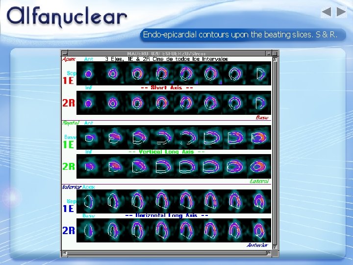 Endo-epicardial contours upon the beating slices. S & R. 