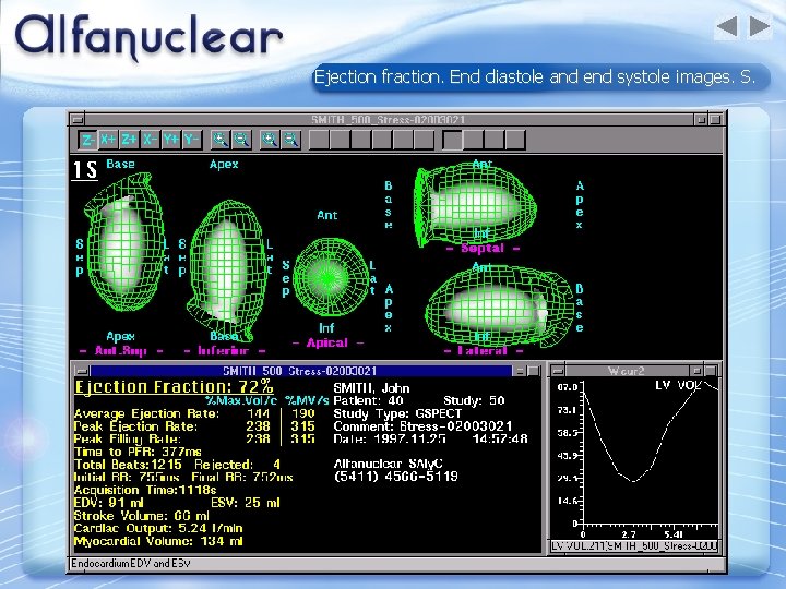Ejection fraction. End diastole and end systole images. S. 