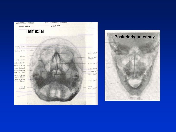 Half axial Posteriorly-anteriorly 