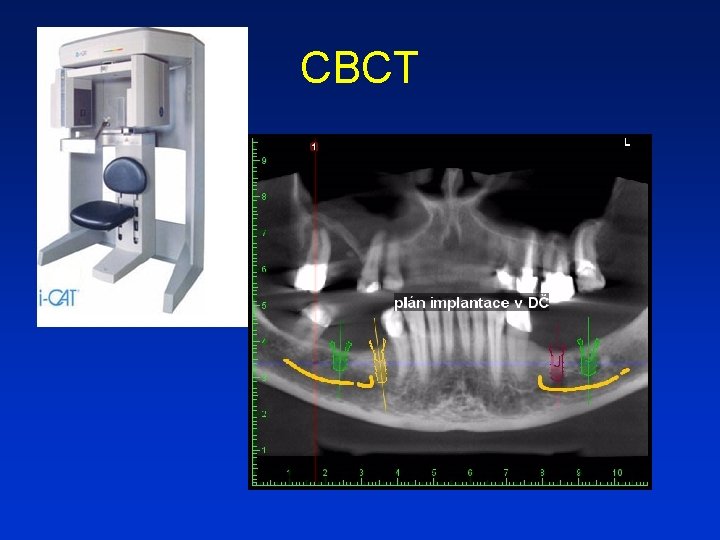 CBCT 