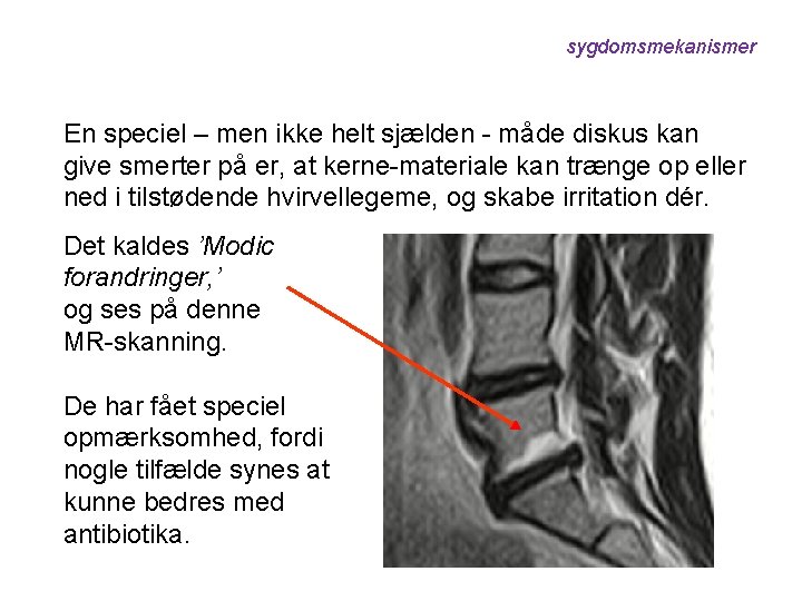 sygdomsmekanismer En speciel – men ikke helt sjælden - måde diskus kan give smerter
