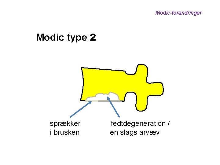 Modic-forandringer Modic type 2 sprækker i brusken fedtdegeneration / en slags arvæv 
