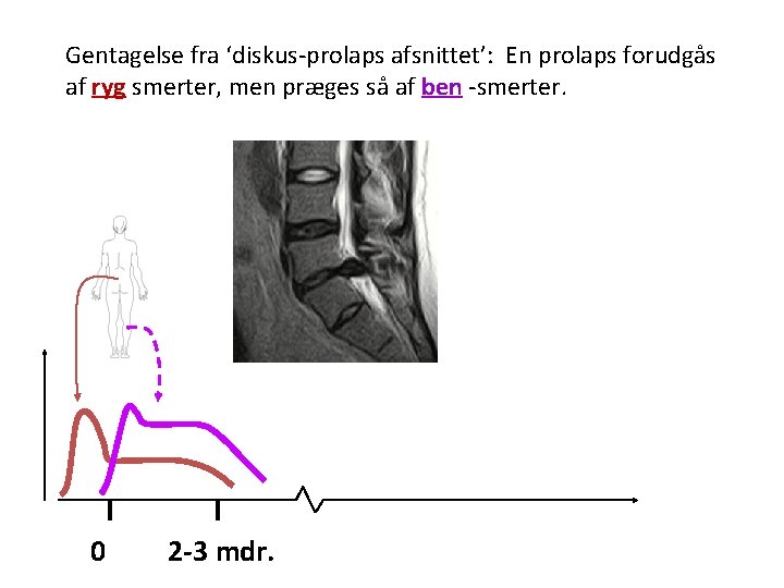 Gentagelse fra ‘diskus-prolaps afsnittet’: En prolaps forudgås af ryg smerter, men præges så af