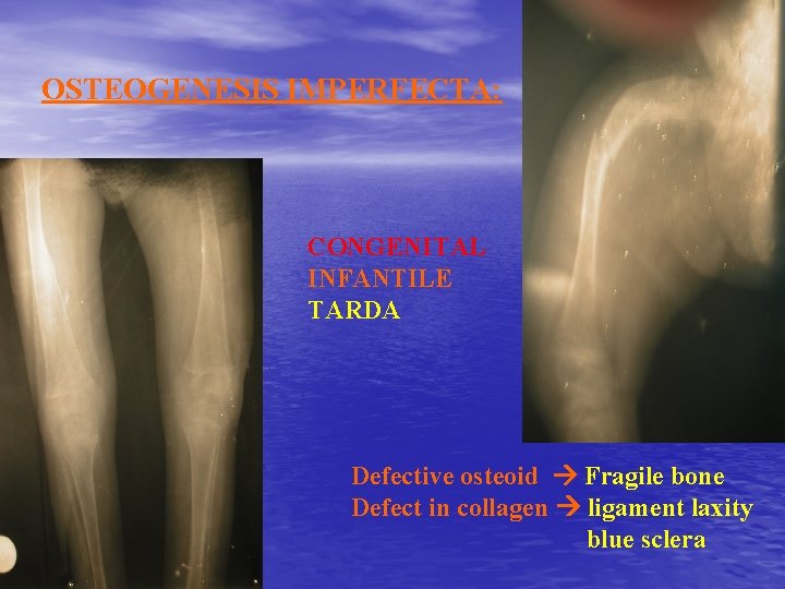 OSTEOGENESIS IMPERFECTA: CONGENITAL INFANTILE TARDA Defective osteoid Fragile bone Defect in collagen ligament laxity