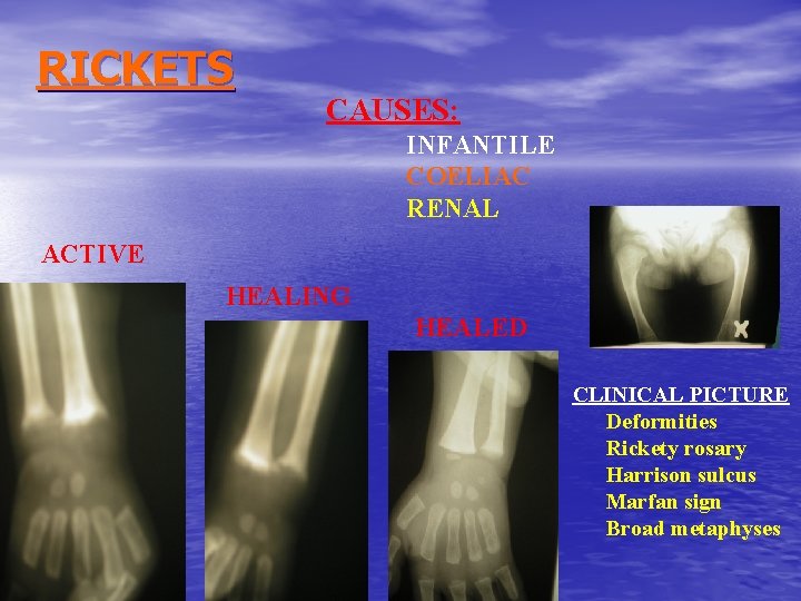RICKETS CAUSES: INFANTILE COELIAC RENAL ACTIVE HEALING HEALED CLINICAL PICTURE Deformities Rickety rosary Harrison