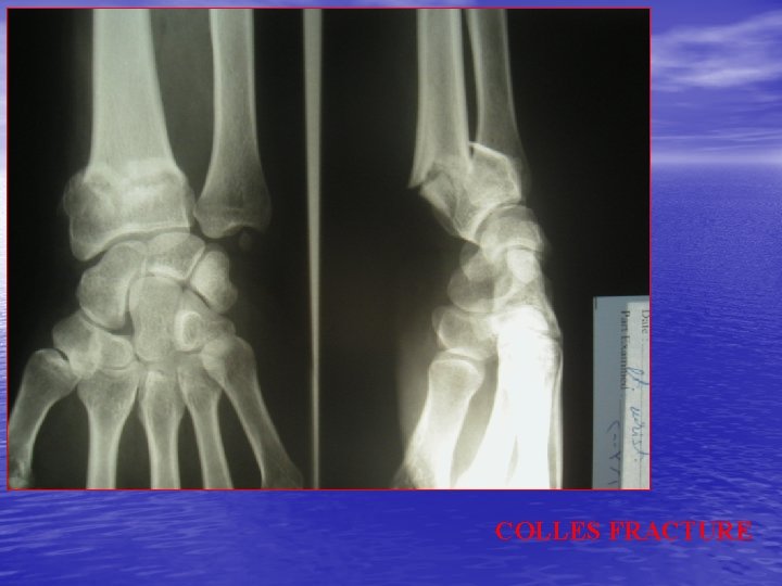 COLLES FRACTURE 